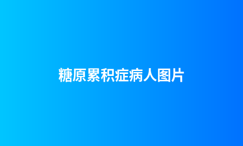 糖原累积症病人图片